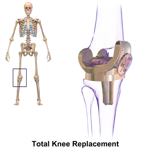 Total knee replacement
